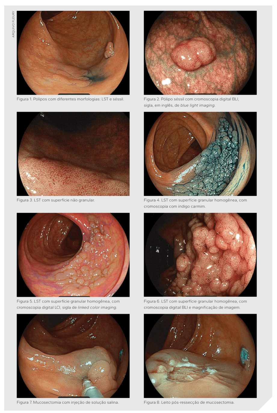 Tumor Papel da colonoscopia no câncer colorretal | Fleury Medicina e Saúde