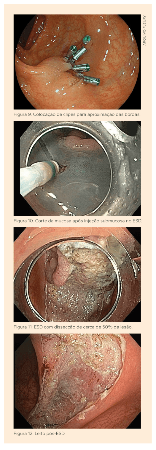 Papel da colonoscopia no câncer colorretal | Fleury Medicina e Saúde